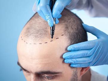 HAIR TRANSPLANT